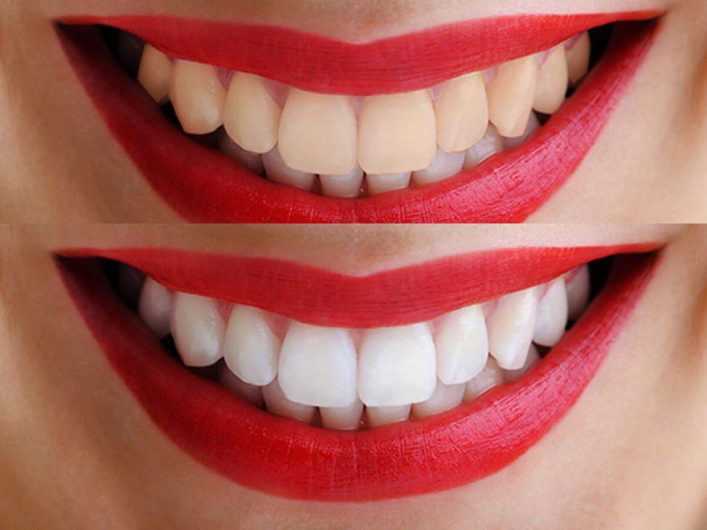 Как работает отбеливание зубов