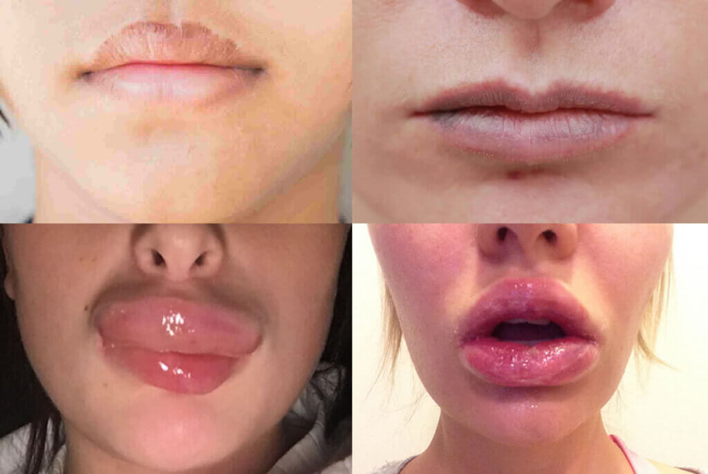 Последствия увеличения губ